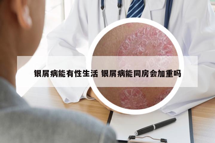 銀屑病能有性生活 銀屑病能同房會(huì)加重嗎