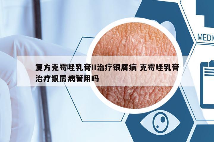 復(fù)方克霉唑乳膏II治療銀屑病 克霉唑乳膏治療銀屑病管用嗎