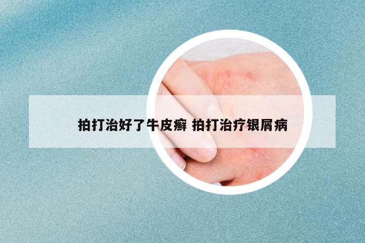 拍打治好了牛皮癬 拍打治療銀屑病
