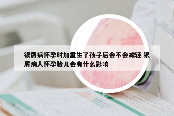 銀屑病懷孕時(shí)加重生了孩子后會(huì)不會(huì)減輕 銀屑病人懷孕胎兒會(huì)有什么影響