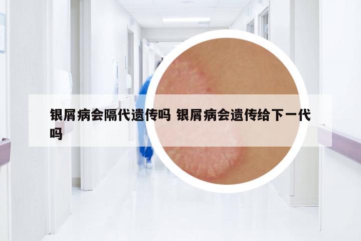 銀屑病會(huì)隔代遺傳嗎 銀屑病會(huì)遺傳給下一代嗎