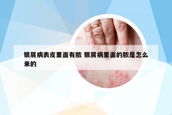 銀屑病表皮里面有膿 銀屑病里面的膿是怎么來的