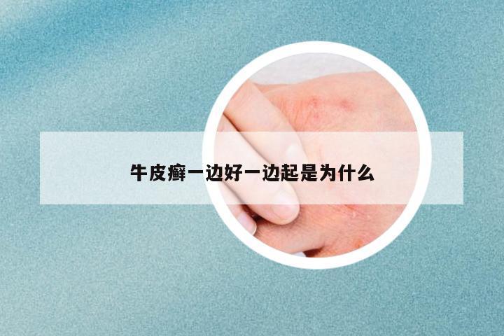 牛皮癬一邊好一邊起是為什么