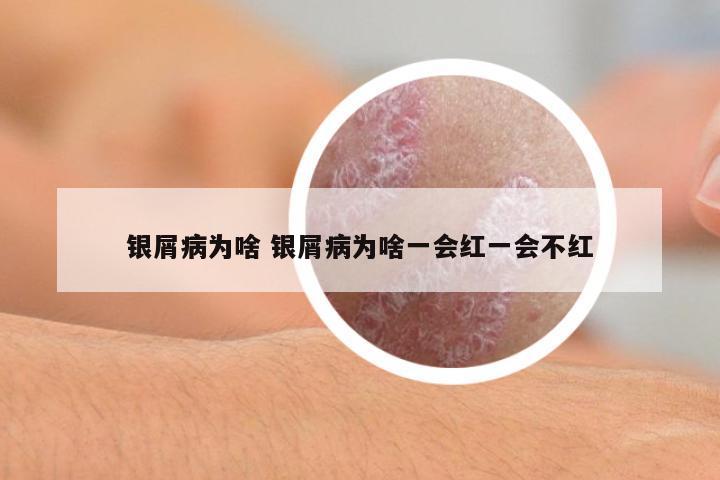 銀屑病為啥 銀屑病為啥一會紅一會不紅