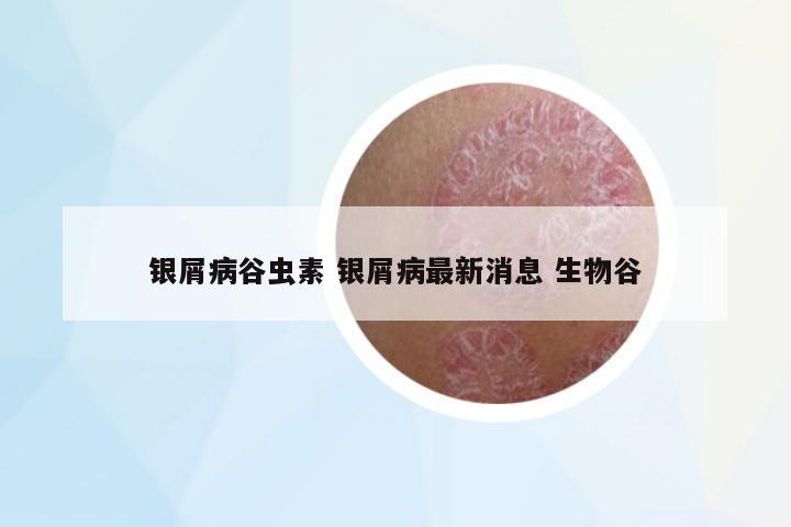 銀屑病谷蟲素 銀屑病最新消息 生物谷