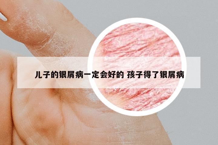 兒子的銀屑病一定會好的 孩子得了銀屑病