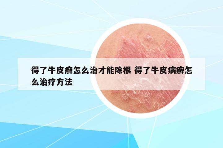 得了牛皮癬怎么治才能除根 得了牛皮病癬怎么治療方法