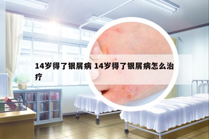 14歲得了銀屑病 14歲得了銀屑病怎么治療