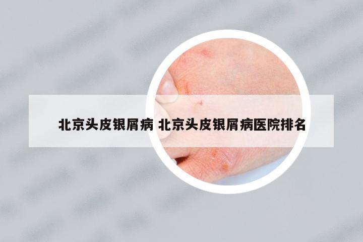 北京頭皮銀屑病 北京頭皮銀屑病醫(yī)院排名