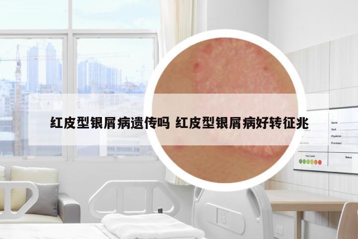 紅皮型銀屑病遺傳嗎 紅皮型銀屑病好轉(zhuǎn)征兆