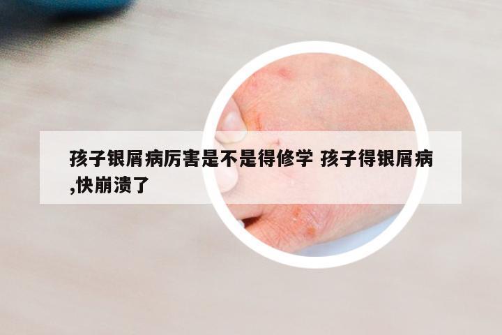 孩子銀屑病厲害是不是得修學(xué) 孩子得銀屑病,快崩潰了