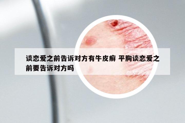 談戀愛之前告訴對方有牛皮癬 平胸談戀愛之前要告訴對方嗎