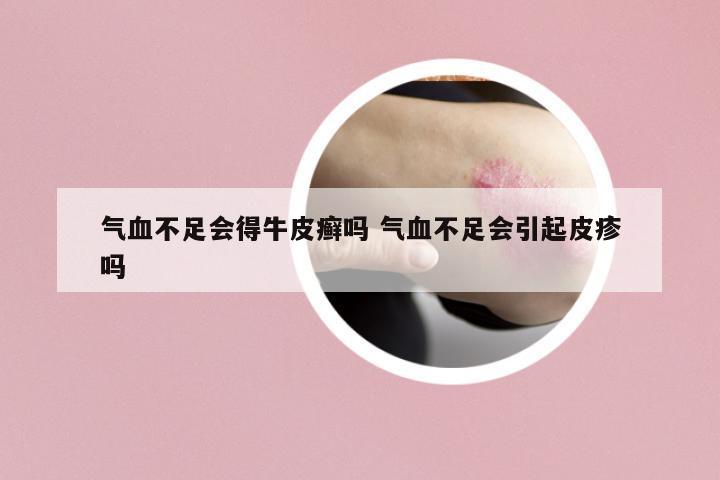 氣血不足會得牛皮癬嗎 氣血不足會引起皮疹嗎