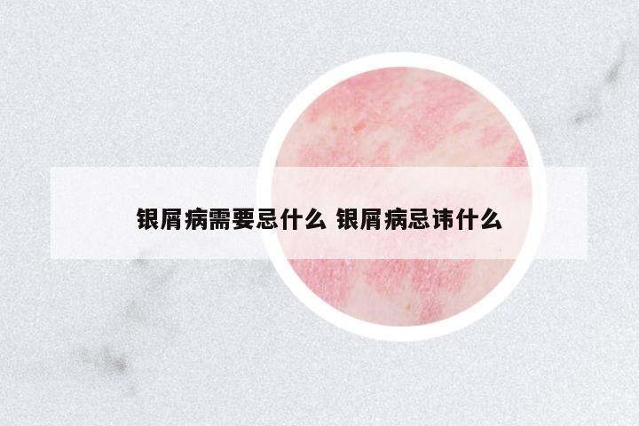 銀屑病需要忌什么 銀屑病忌諱什么