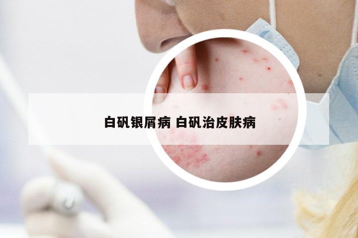 白礬銀屑病 白礬治皮膚病