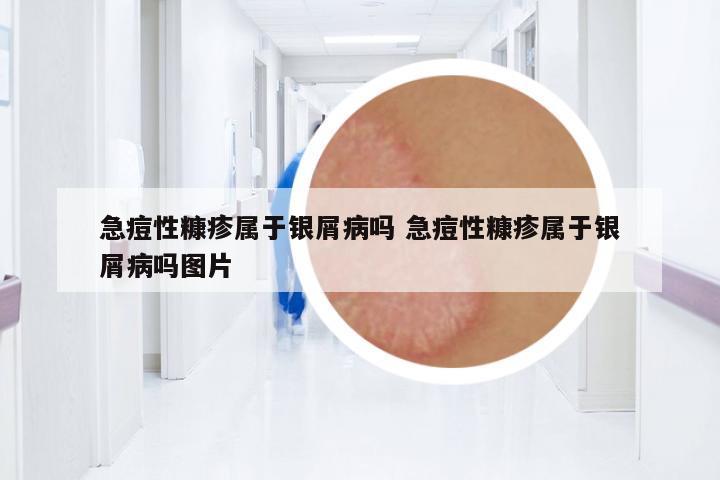 急痘性糠疹屬于銀屑病嗎 急痘性糠疹屬于銀屑病嗎圖片