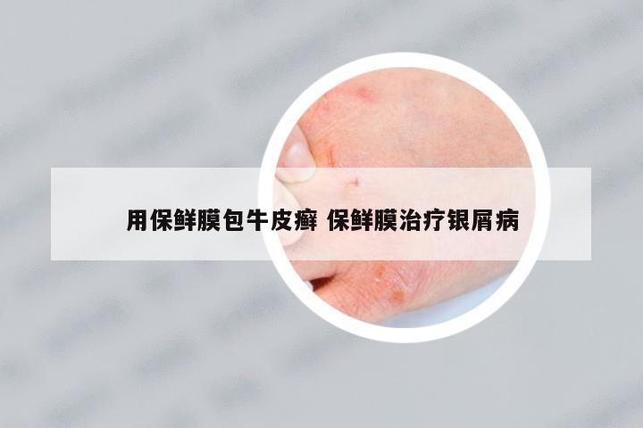 用保鮮膜包牛皮癬 保鮮膜治療銀屑病