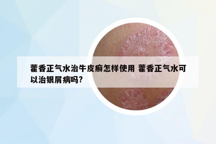 藿香正氣水治牛皮癬怎樣使用 藿香正氣水可以治銀屑病嗎?