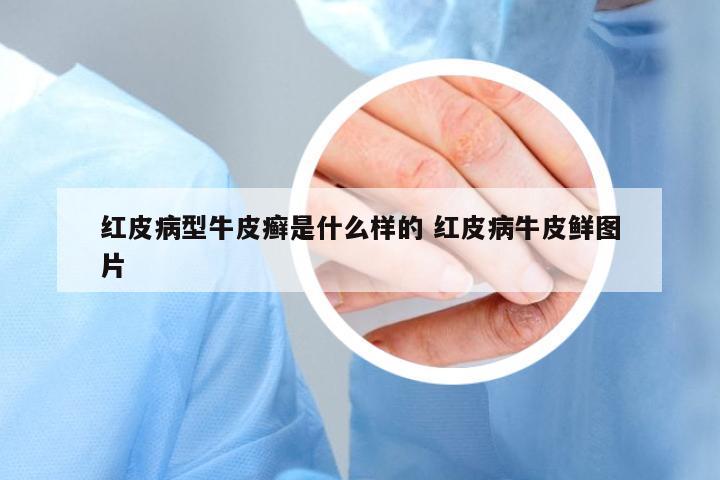 紅皮病型牛皮癬是什么樣的 紅皮病牛皮鮮圖片