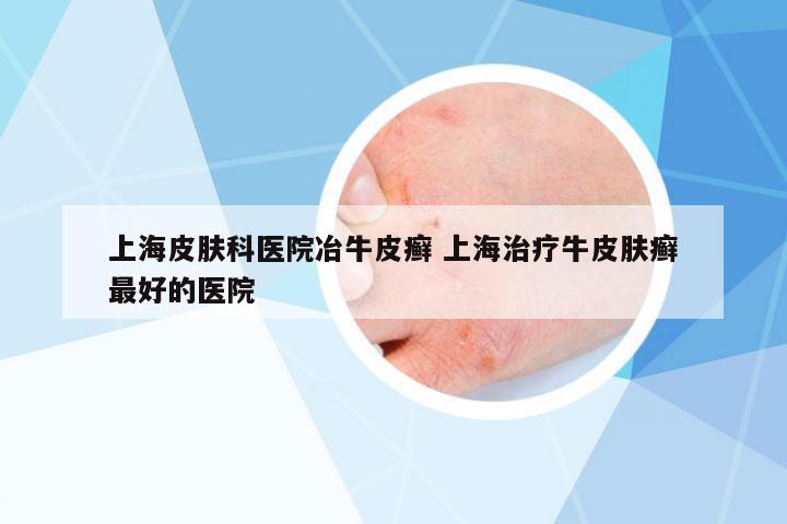 上海皮膚科醫(yī)院冶牛皮癬 上海治療牛皮膚癬最好的醫(yī)院