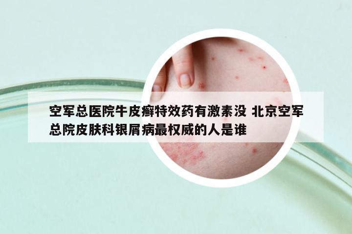 空軍總醫(yī)院牛皮癬特效藥有激素沒 北京空軍總院皮膚科銀屑病最權威的人是誰