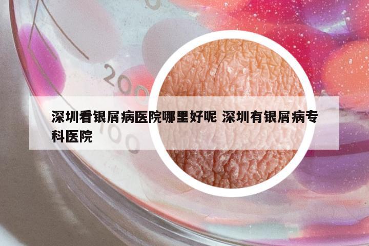 深圳看銀屑病醫(yī)院哪里好呢 深圳有銀屑病專科醫(yī)院