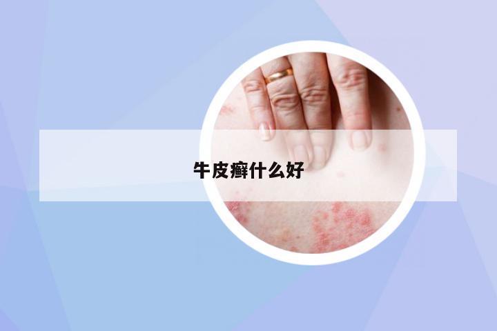 牛皮癬什么好