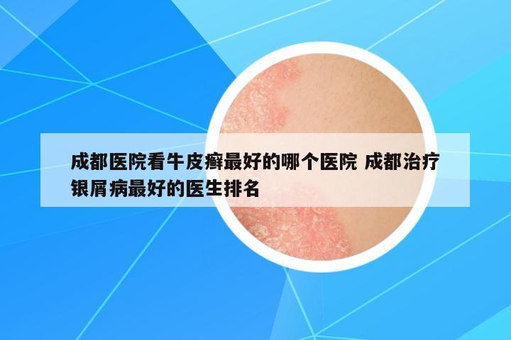 成都醫(yī)院看牛皮癬最好的哪個(gè)醫(yī)院 成都治療銀屑病最好的醫(yī)生排名