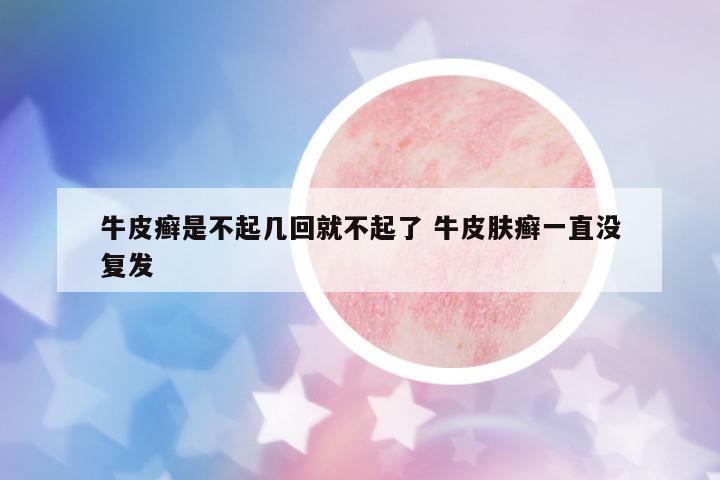 牛皮癬是不起幾回就不起了 牛皮膚癬一直沒復發(fā)