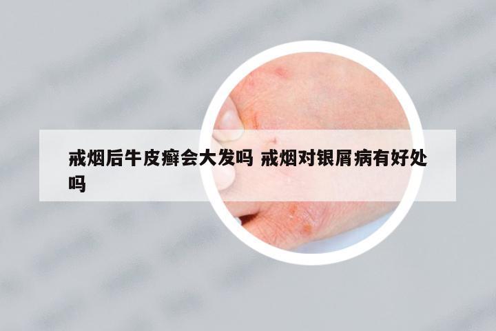 戒煙后牛皮癬會(huì)大發(fā)嗎 戒煙對(duì)銀屑病有好處嗎