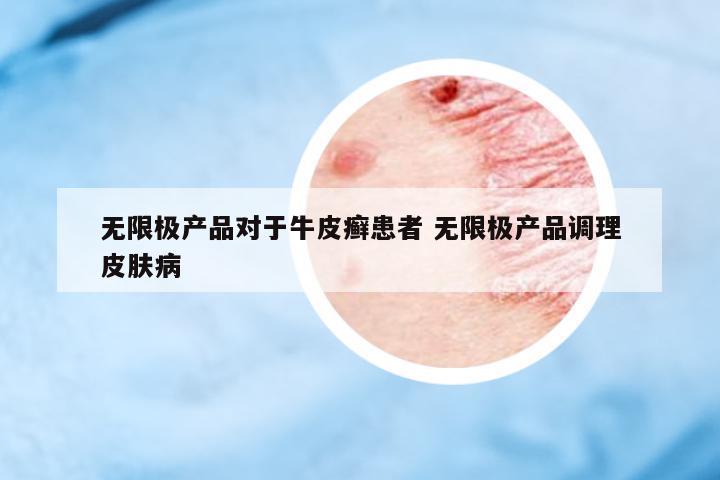 無限極產(chǎn)品對(duì)于牛皮癬患者 無限極產(chǎn)品調(diào)理皮膚病