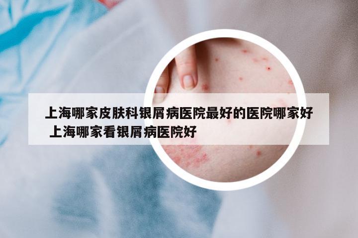 上海哪家皮膚科銀屑病醫(yī)院最好的醫(yī)院哪家好 上海哪家看銀屑病醫(yī)院好