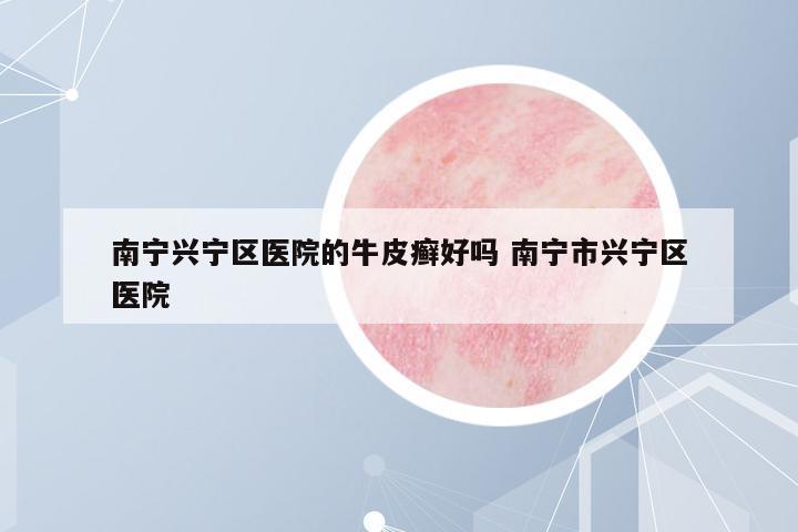 南寧興寧區(qū)醫(yī)院的牛皮癬好嗎 南寧市興寧區(qū)醫(yī)院