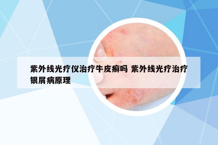 紫外線光療儀治療牛皮癬嗎 紫外線光療治療銀屑病原理