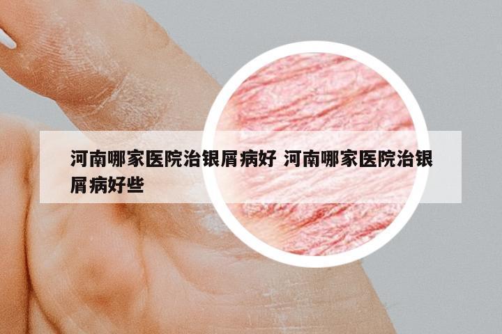 河南哪家醫(yī)院治銀屑病好 河南哪家醫(yī)院治銀屑病好些