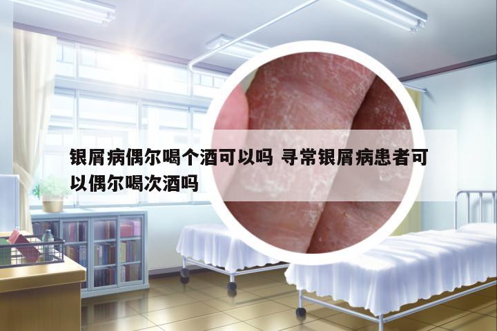 銀屑病偶爾喝個酒可以嗎 尋常銀屑病患者可以偶爾喝次酒嗎