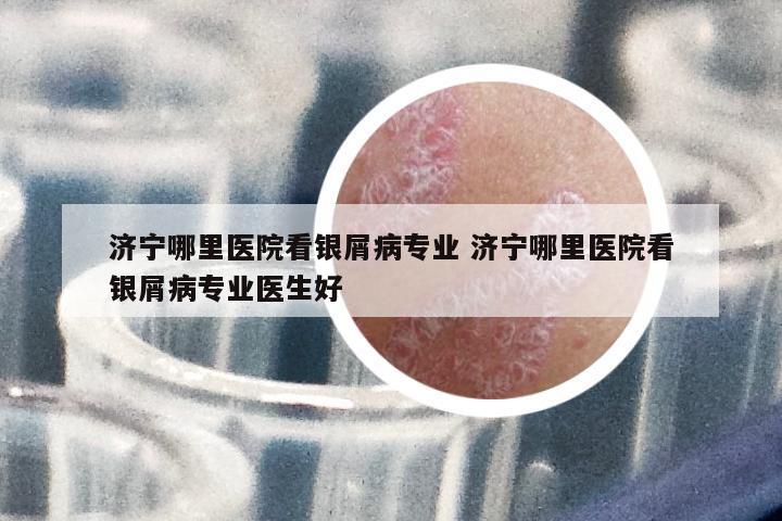 濟(jì)寧哪里醫(yī)院看銀屑病專業(yè) 濟(jì)寧哪里醫(yī)院看銀屑病專業(yè)醫(yī)生好