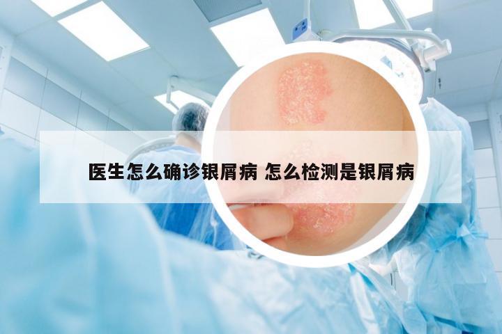 醫(yī)生怎么確診銀屑病 怎么檢測是銀屑病