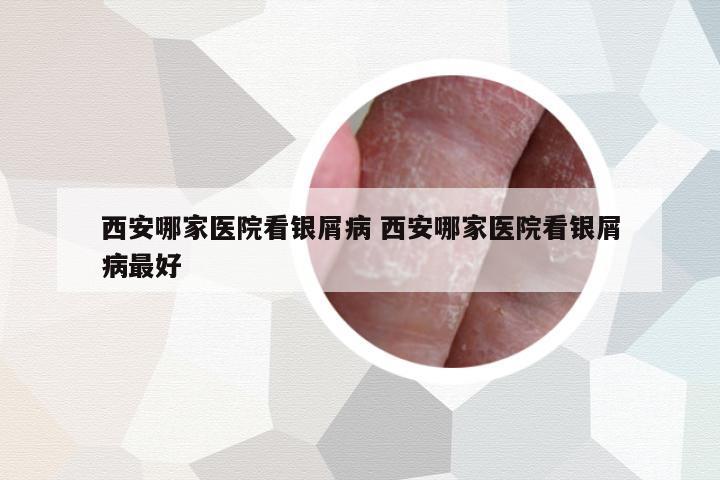 西安哪家醫(yī)院看銀屑病 西安哪家醫(yī)院看銀屑病最好