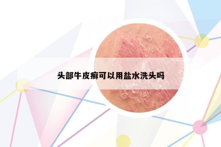 頭部牛皮癬可以用鹽水洗頭嗎