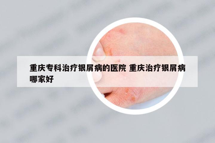 重慶專科治療銀屑病的醫(yī)院 重慶治療銀屑病哪家好