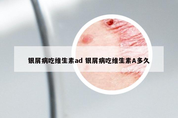 銀屑病吃維生素ad 銀屑病吃維生素A多久