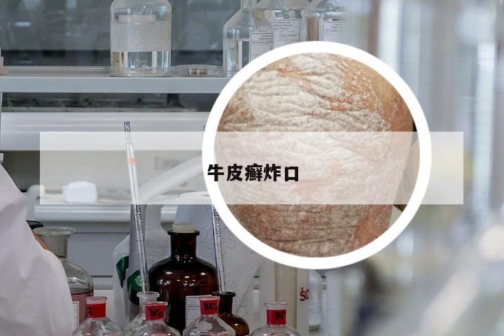 牛皮癬炸口