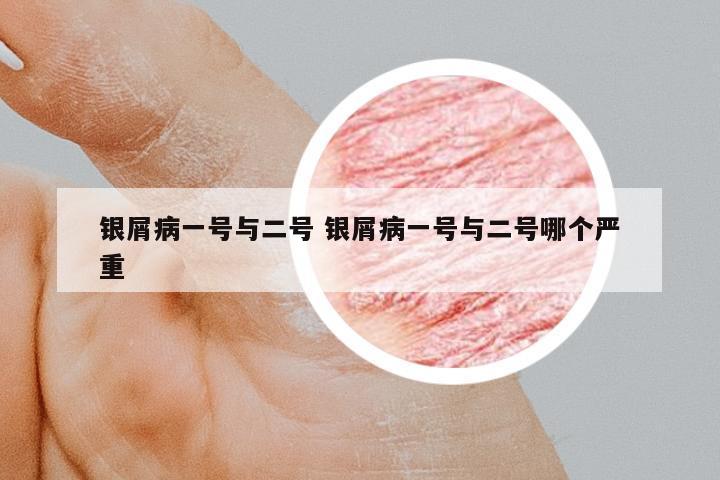 銀屑病一號與二號 銀屑病一號與二號哪個嚴(yán)重