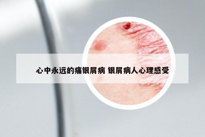 心中永遠的痛銀屑病 銀屑病人心理感受