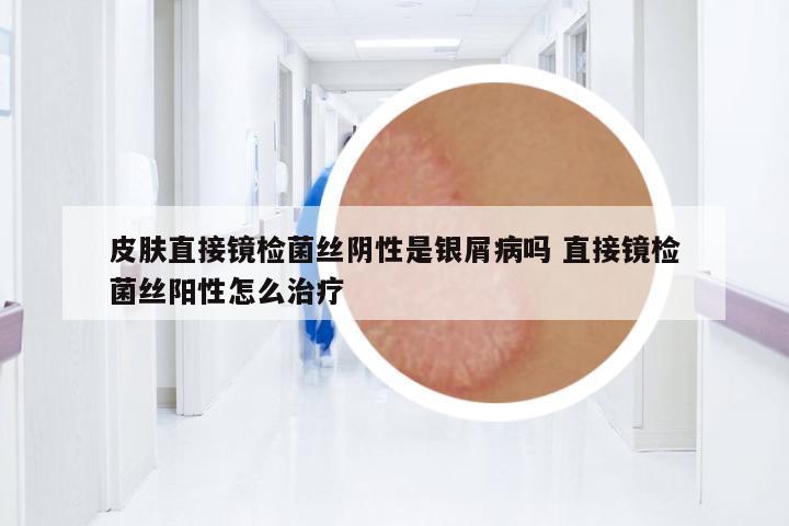 皮膚直接鏡檢菌絲陰性是銀屑病嗎 直接鏡檢菌絲陽(yáng)性怎么治療