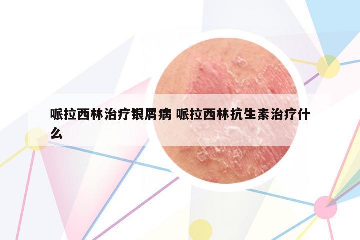 哌拉西林治療銀屑病 哌拉西林抗生素治療什么