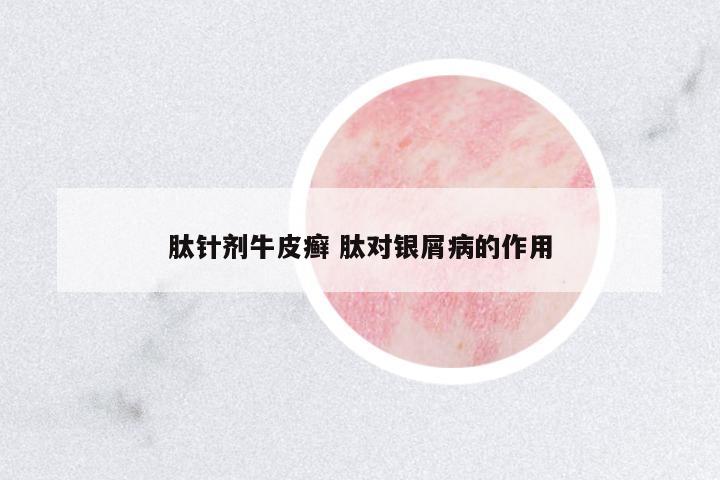 肽針劑牛皮癬 肽對(duì)銀屑病的作用