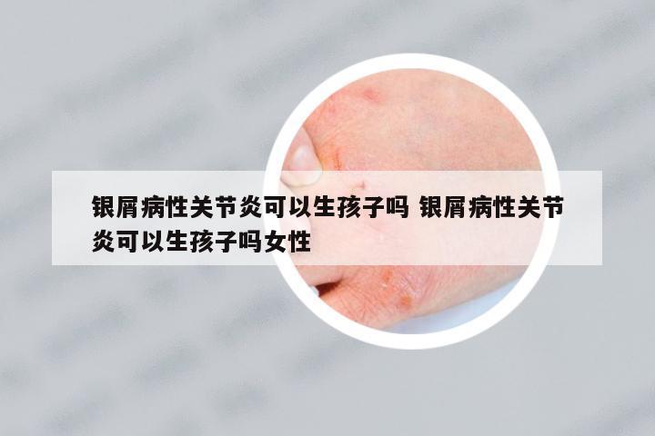 銀屑病性關(guān)節(jié)炎可以生孩子嗎 銀屑病性關(guān)節(jié)炎可以生孩子嗎女性