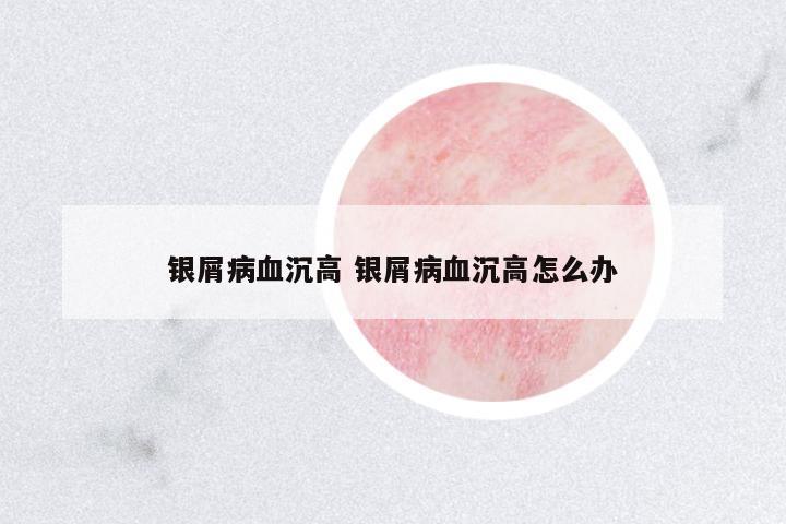 銀屑病血沉高 銀屑病血沉高怎么辦